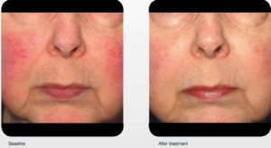 delray-dermatology-laser-services-cheeks