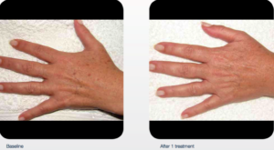 delray-dermatology-laser-services-hands