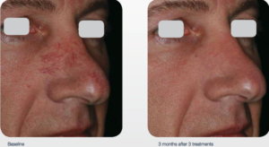 delray-dermatology-laser-services-nose