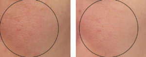 delray-dermatology-oxygeneo-neobright-skin