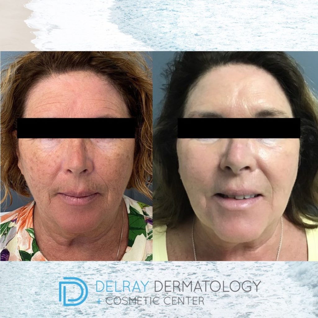 Laser Services - Delray Dermatology + Cosmetic Center | Delray Beach  Dermatologist