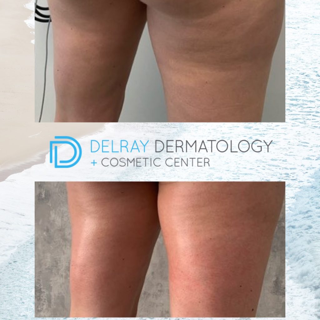 Laser Services - Delray Dermatology + Cosmetic Center | Delray Beach  Dermatologist